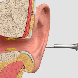 Visual EarCam Pro™ — Limpiador de Oídos con Cámara HD